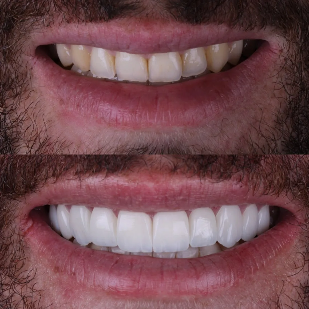 Antes e depois de tratamento com lentes de resina