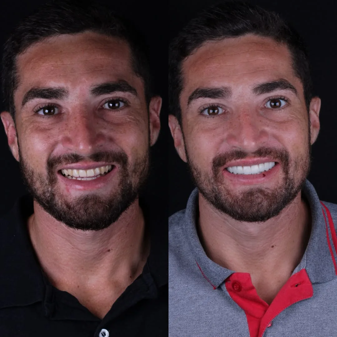 Antes e depois de dentes tratados com lentes de resina
