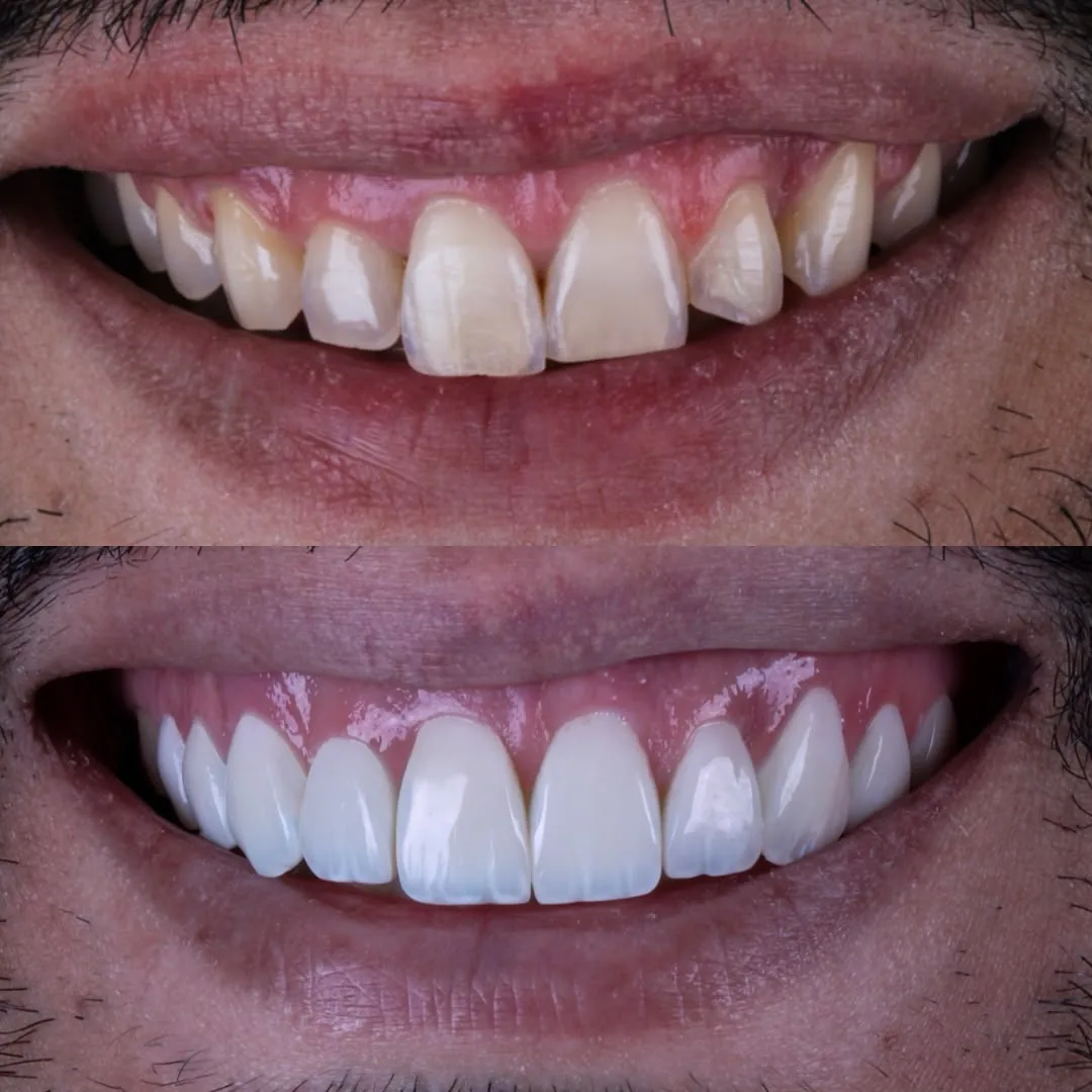 Detalhe de sorriso natural com lentes de resina