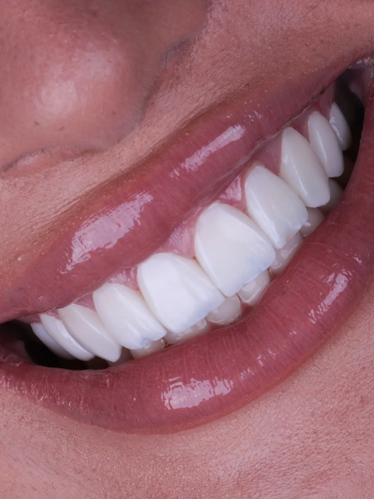 Sorriso lateral após lentes de resina