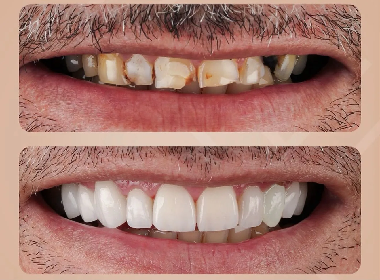 Sorriso natural resultado de lentes de resina